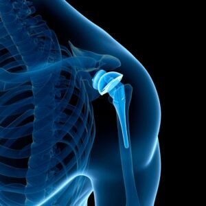 Cirugía de Prótesis de Hombro