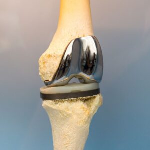 Cirugía de Prótesis de Rodilla