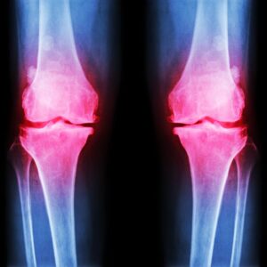Osteoartritis