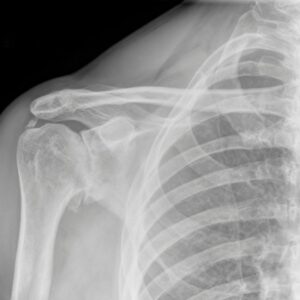 Osteoartrosis de Hombro (Desgaste de Hombro)