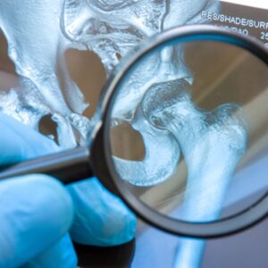 Osteoartrosis de Cadera